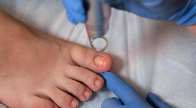 Beat the Summer Foot Fungus Blues: Keep Your Feet Dry and Happy