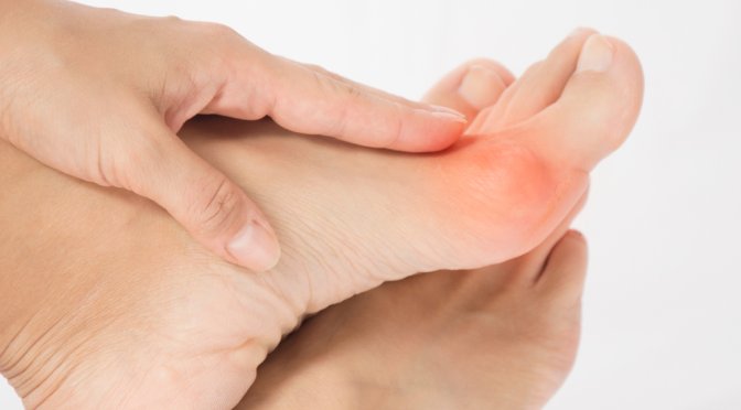 Minimally Invasive Bunion Surgery vs Lapiplasty: Understanding the Differences