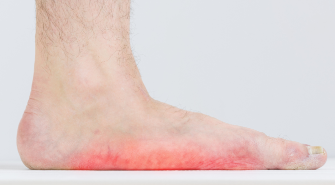 What to Do if You Have Flat Feet, Problems & How to Resolve Them