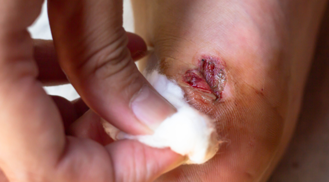 The Basics of Wound Care: Keeping Your Feet Healthy When Accidents Happen