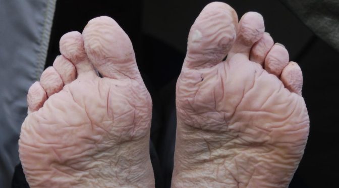 The Perils of Wet Shoes: Trench Foot and Frostbite