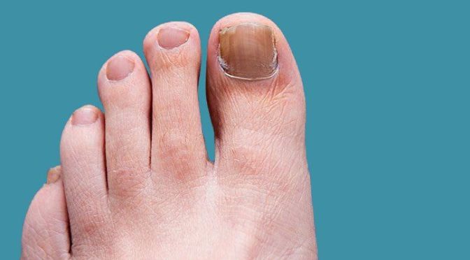 CN-U: A New Treatment Option in the Fight Against Toenail Fungus