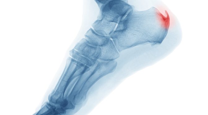 Achilles Heel Spur Removal: What You Need to Know