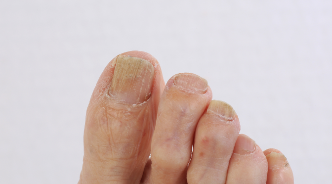 Types of Foot Fungus and How to Prevent Them
