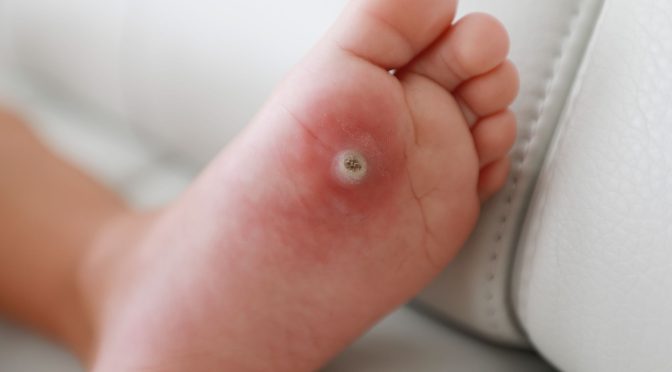 Essential Wound Care for Diabetic Foot Ulcers and Venous Leg Ulcers