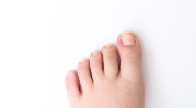 Tips for Preventing and Treating Ingrown Toenails