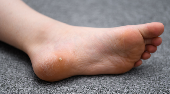 What Causes Plantar Warts and How to Treat Them